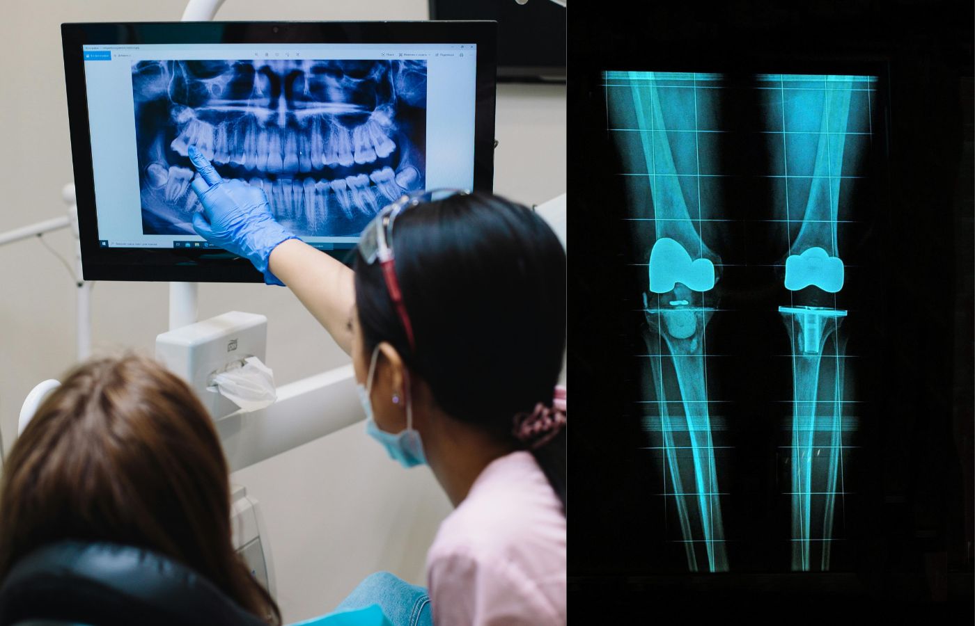X-Ray AP and LAT Views Help in Diagnosis